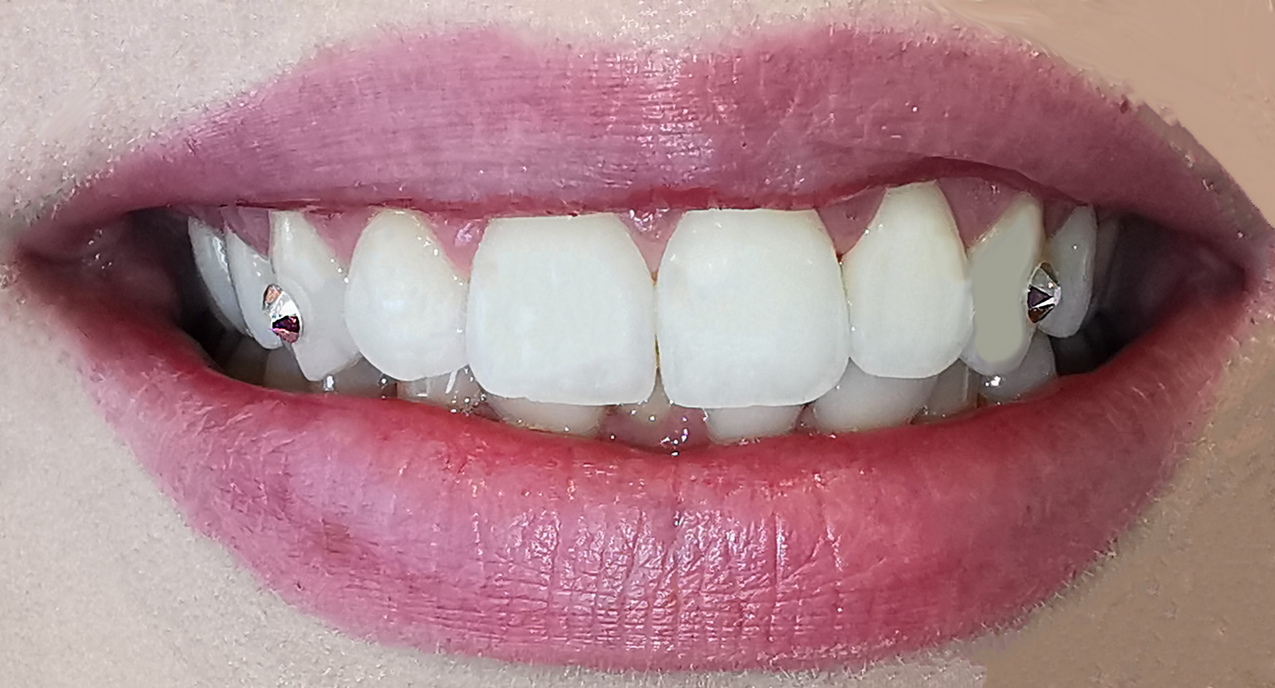 Tooth Gem Patient